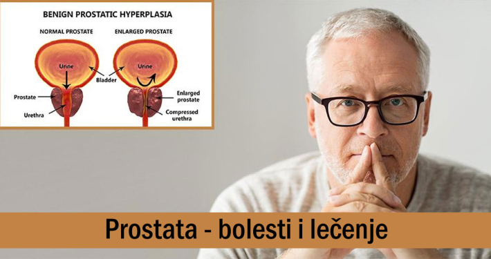 Prostata - bolesti i lečenje